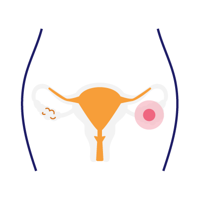 Debiopharm-Trial-Ovarian Cancer