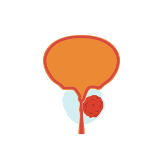 Prostate Cancer